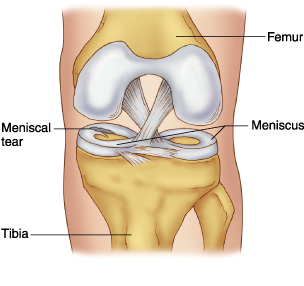 Meniscus Tear